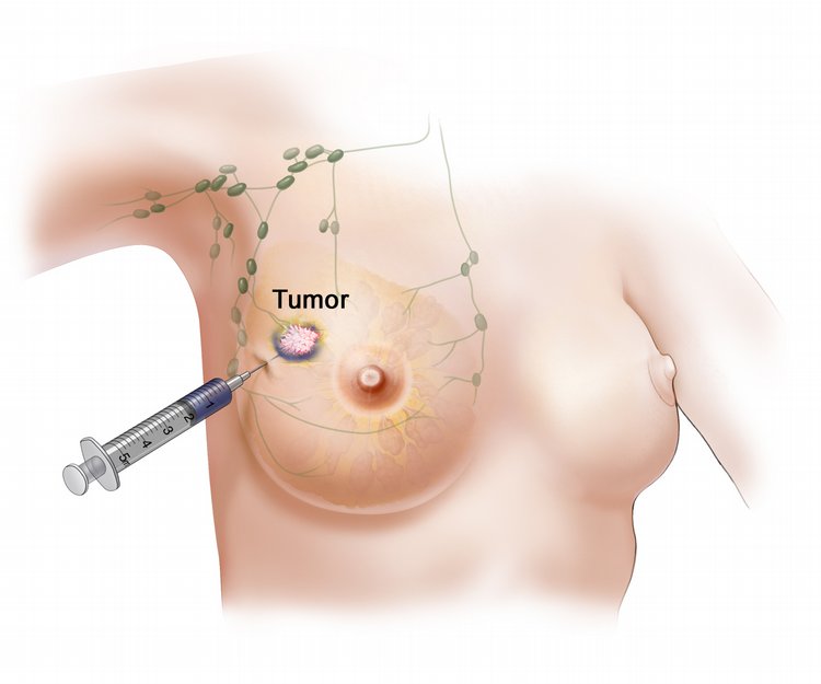 Breast Biopsy Dubai
